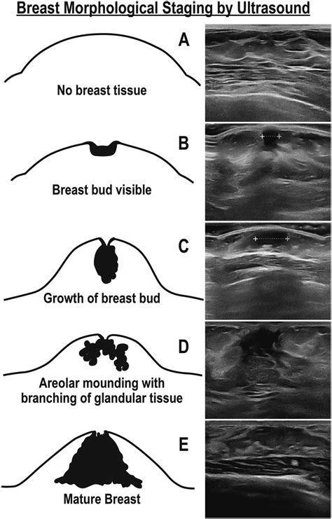 teenager boobs|Normal Breast Development and Changes